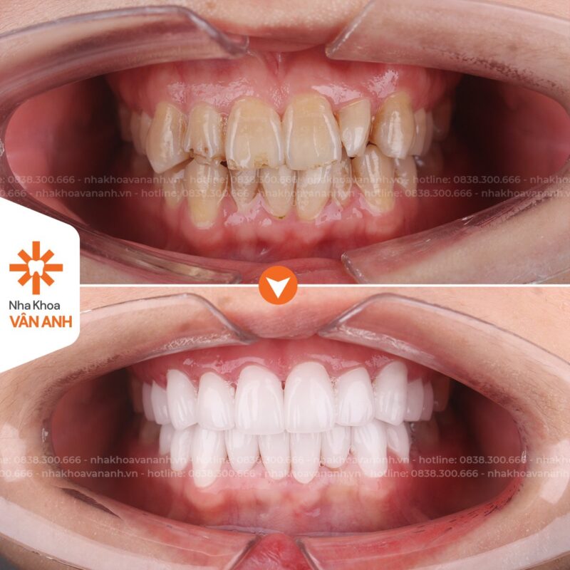 bọc răng sứ nha khoa vân anh