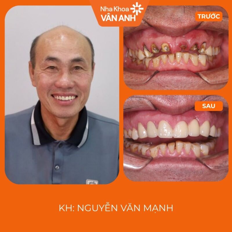 răng sứ nha khoa vân anh