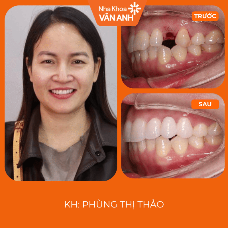 KH răng sứ nha khoa vân anh