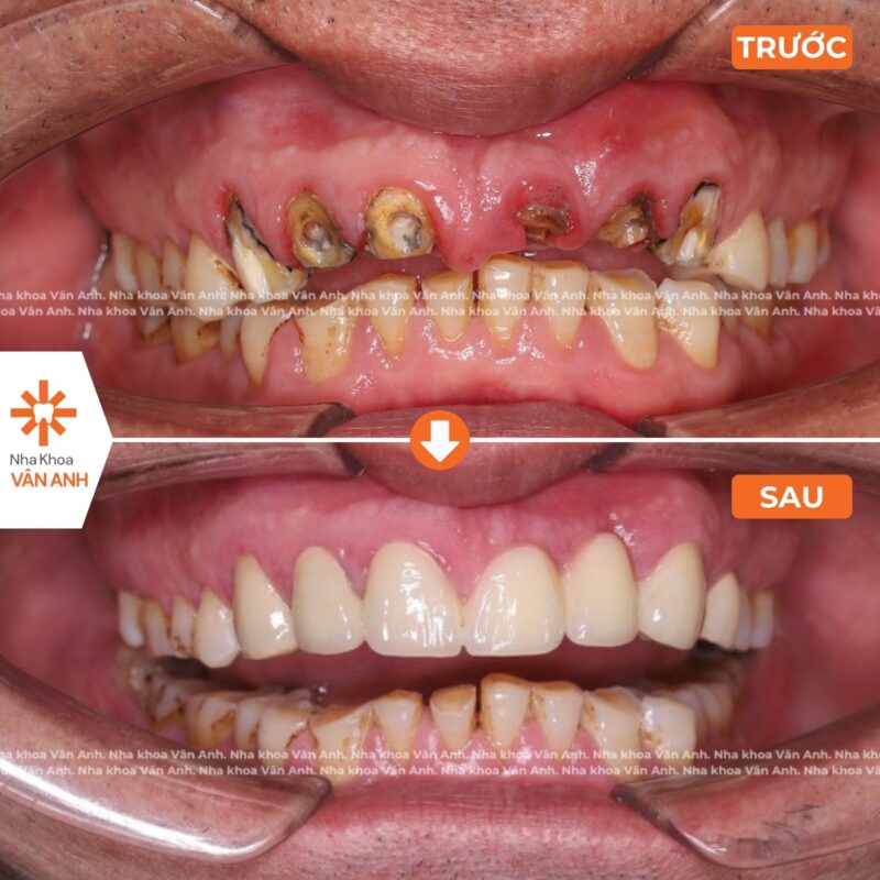bọc răng sứ nha khoa vân anh