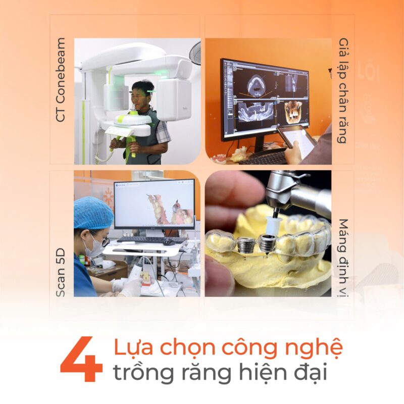 công nghệ trồng răng implant