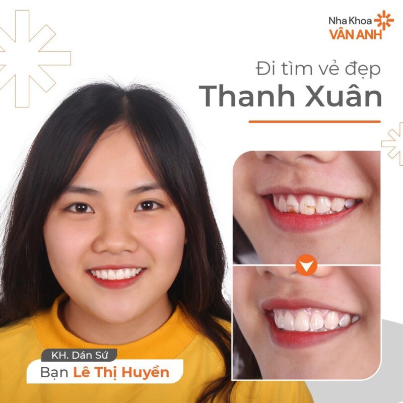 dán sứ veneer nha khoa vân anh