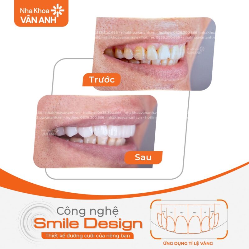 dán sứ veneer nha khoa vân anh