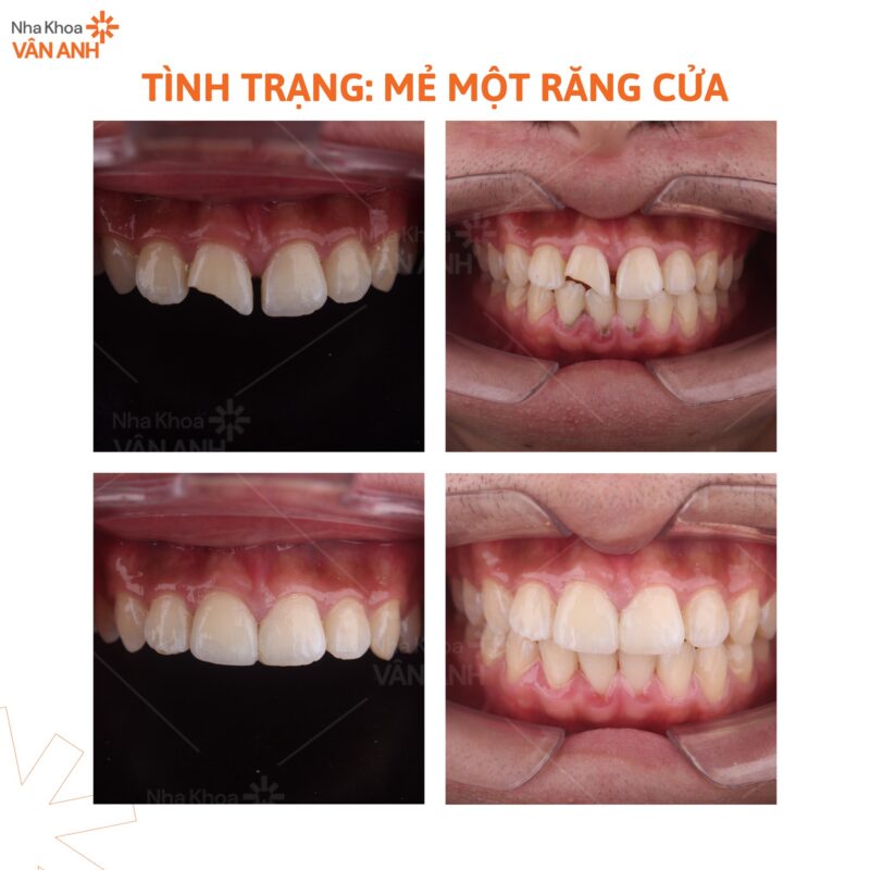 dán sứ veneer nha khoa vân anh