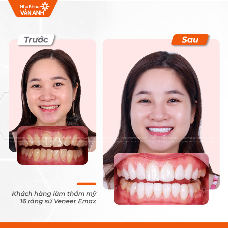 dán sứ veneer nha khoa vân anh