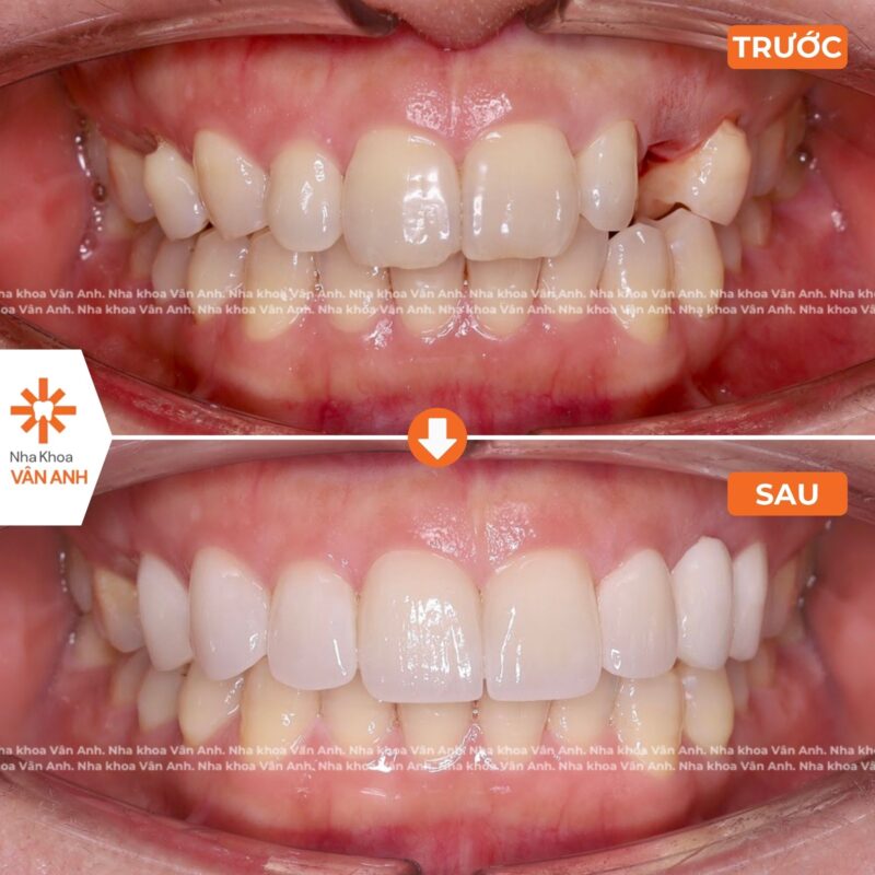 dán sứ veneer nha khoa vân anh