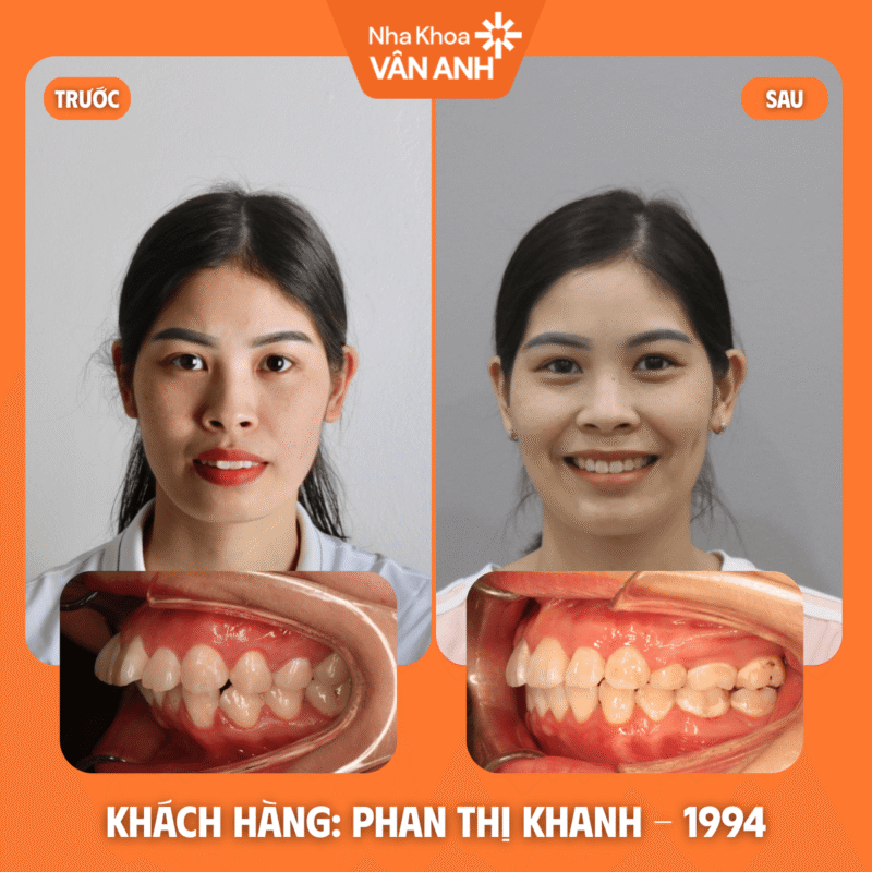 niềng răng nha khoa vân anh
