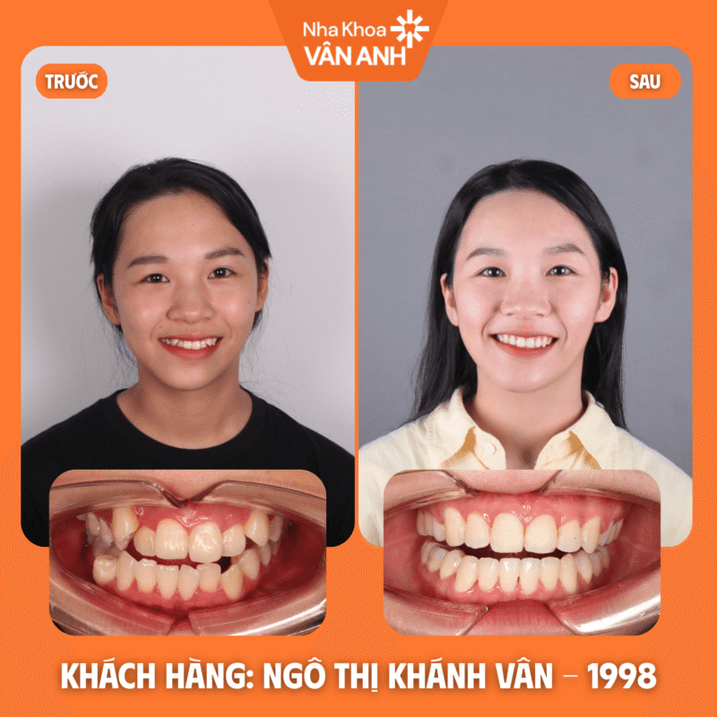 niềng răng nha khoa vân anh