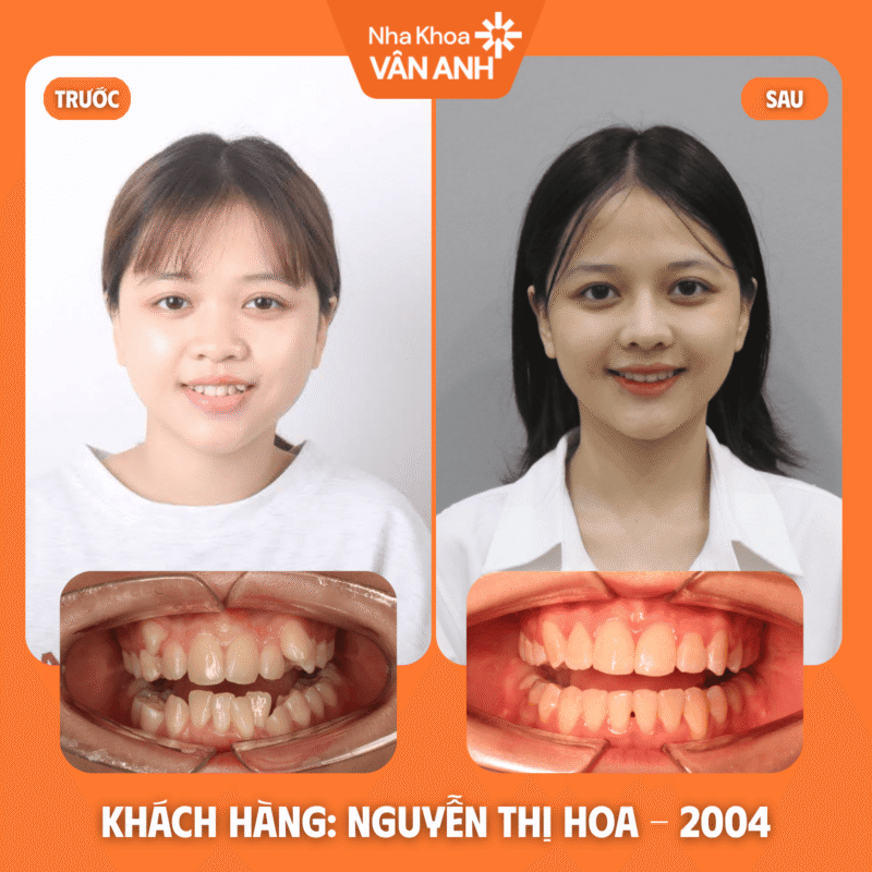 niềng răng nha khoa vân anh