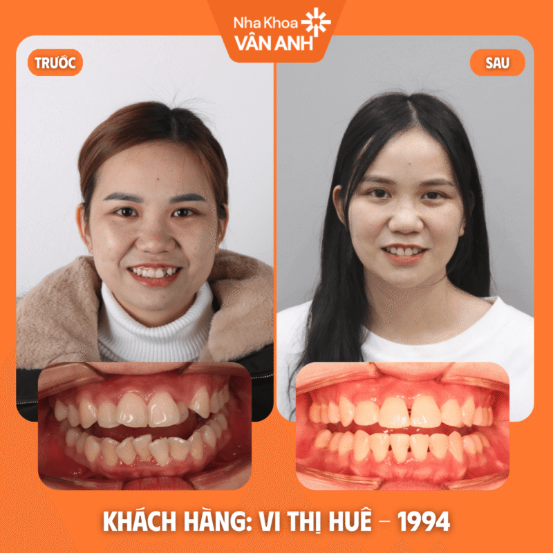 niềng răng nha khoa vân anh