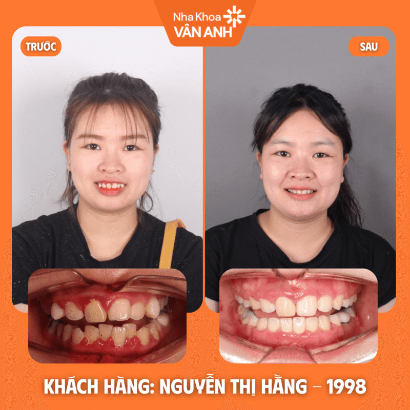 niềng răng nha khoa vân anh