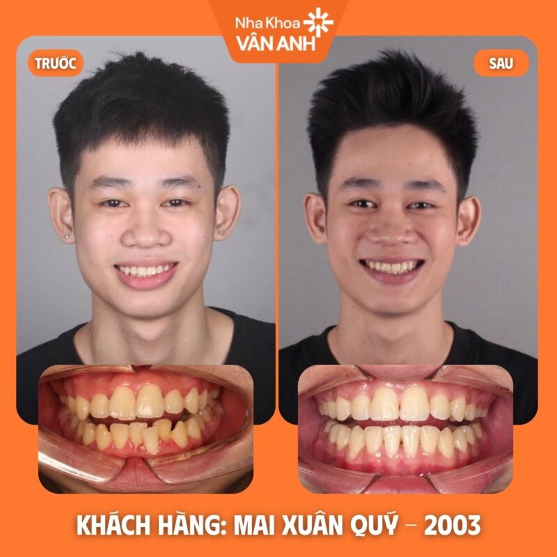 niềng răng nha khoa vân anh