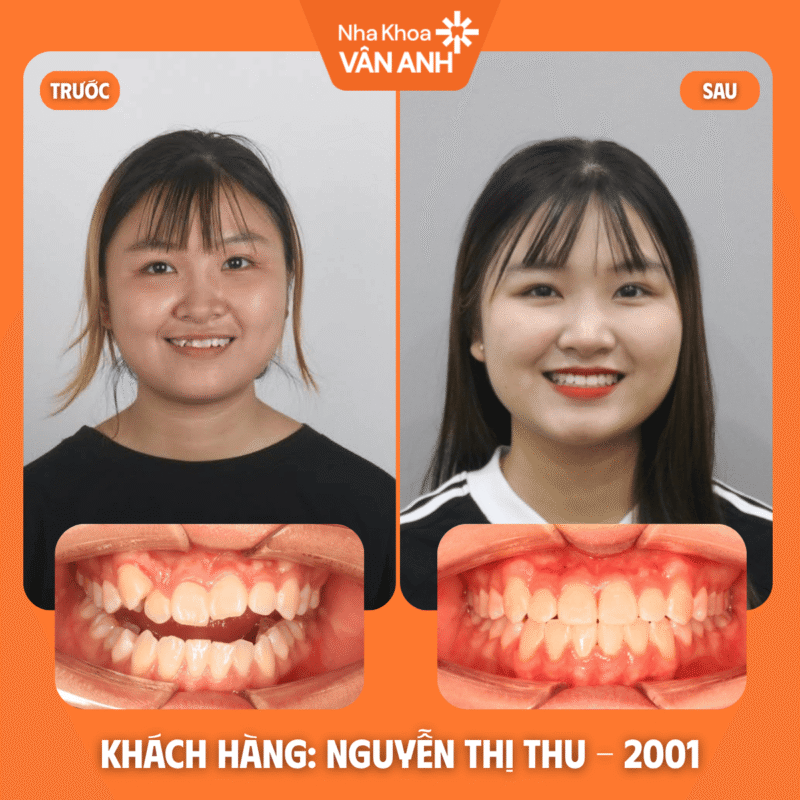 niềng răng nha khoa vân anh