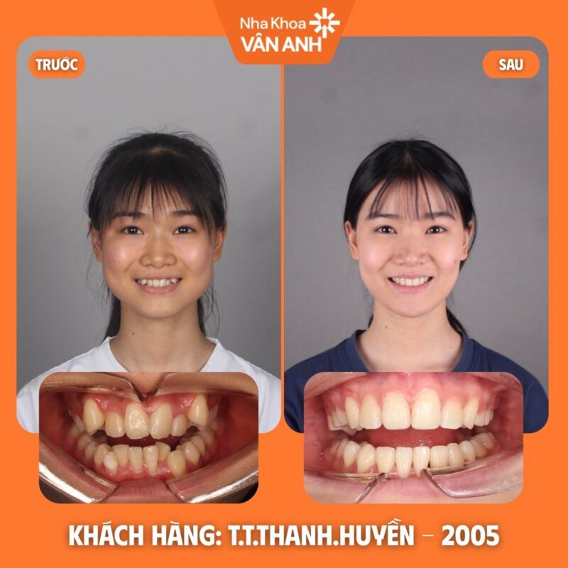 niềng răng nha khoa vân anh