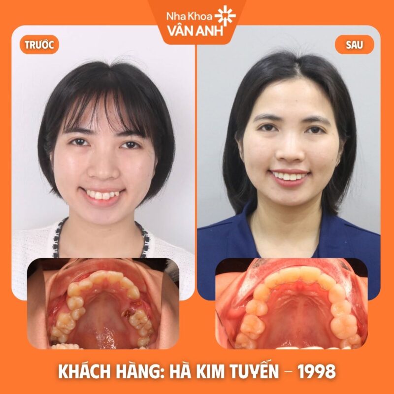 niềng răng nha khoa vân anh