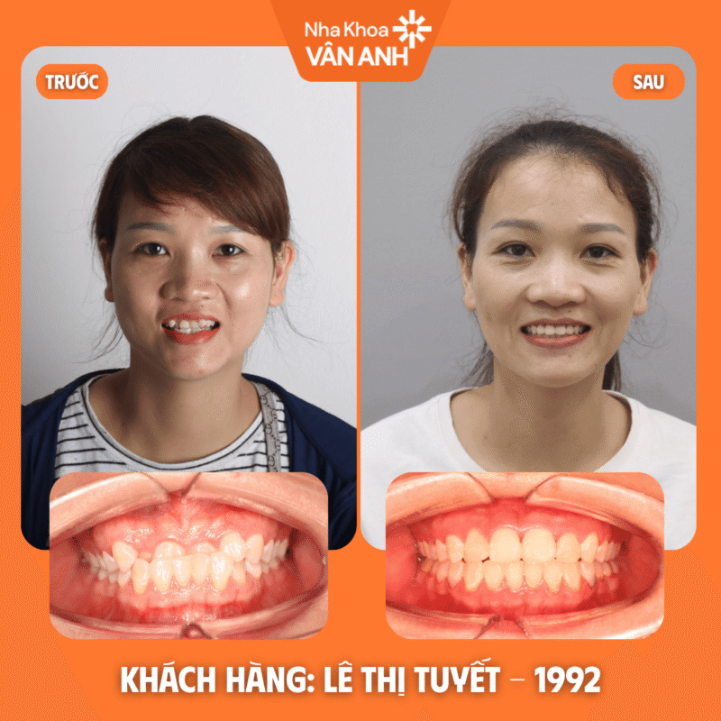 niềng răng nha khoa vân anh