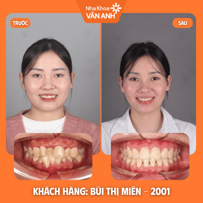 niềng răng nha khoa vân anh