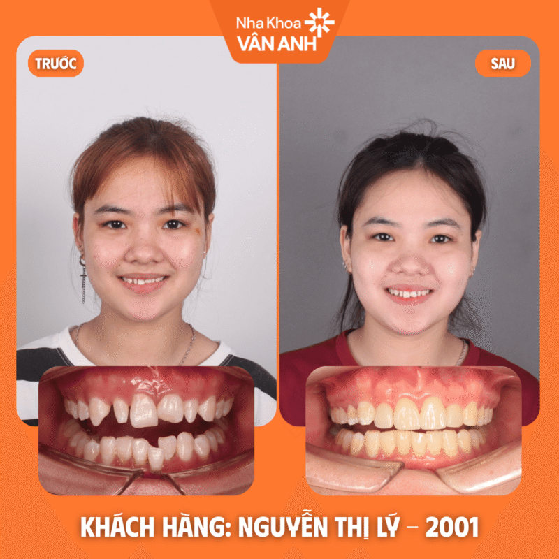 niềng răng nha khoa vân anh