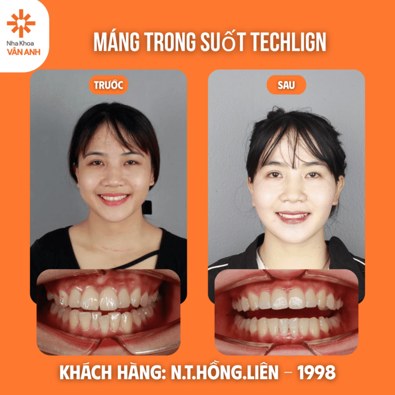 niềng răng trong suốt techlign nha khoa vân anh