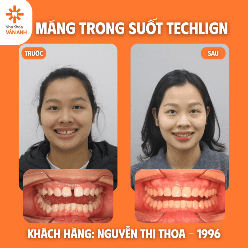 niềng răng trong suốt techlign nha khoa vân anh