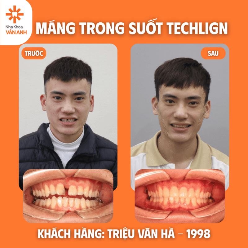 niềng răng trong suốt techlign nha khoa vân anh