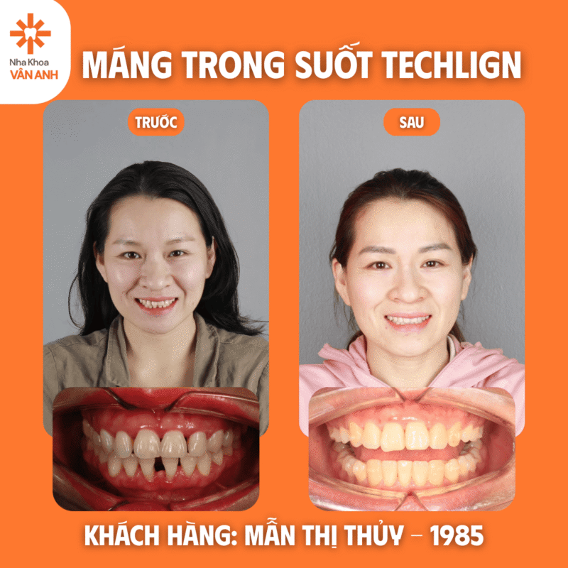 niềng răng trong suốt techlign nha khoa vân anh