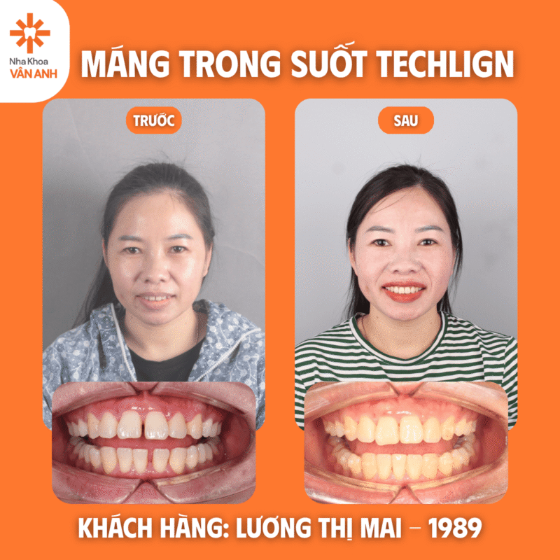 niềng răng trong suốt techlign nha khoa vân anh