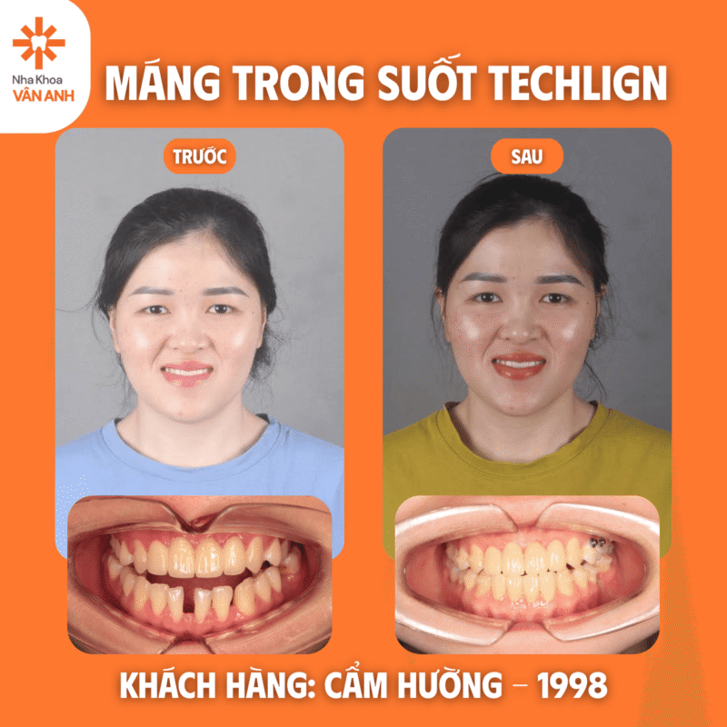 niềng răng trong suốt techlign nha khoa vân anh