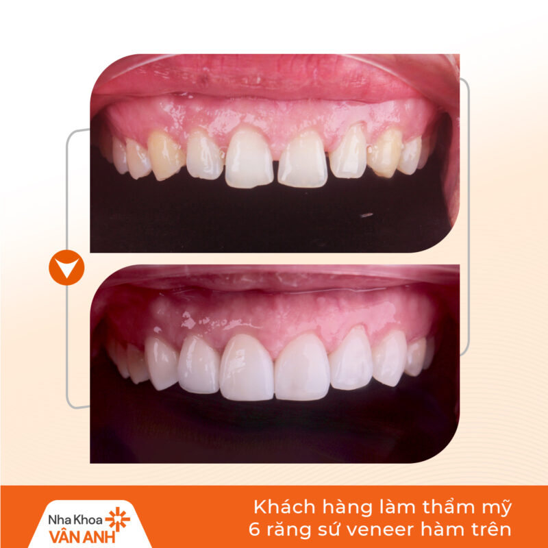 dán sứ veneer nha khoa vân anh