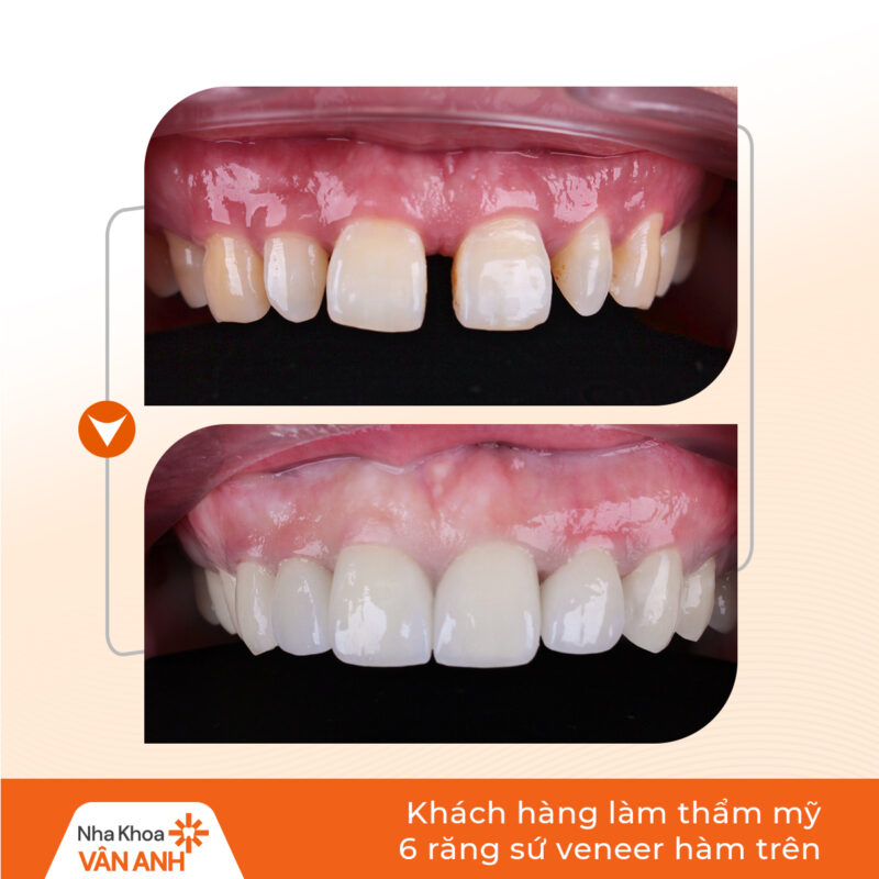 dán sứ veneer nha khoa vân anh