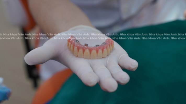 răng tạm trên implant