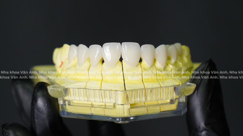 bọc răng sứ orodent nha khoa vân anh