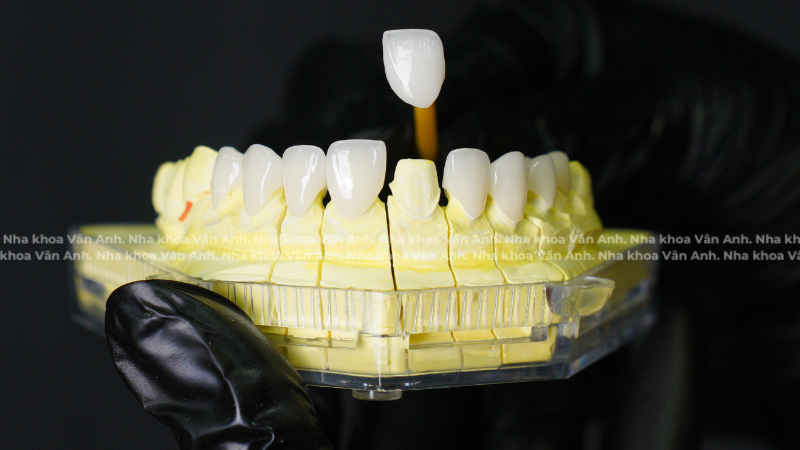 bọc răng sứ orodent nha khoa vân anh