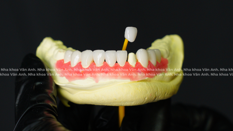 bọc răng sứ orodent nha khoa vân anh