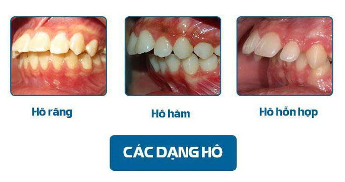 Các dạng răng hô