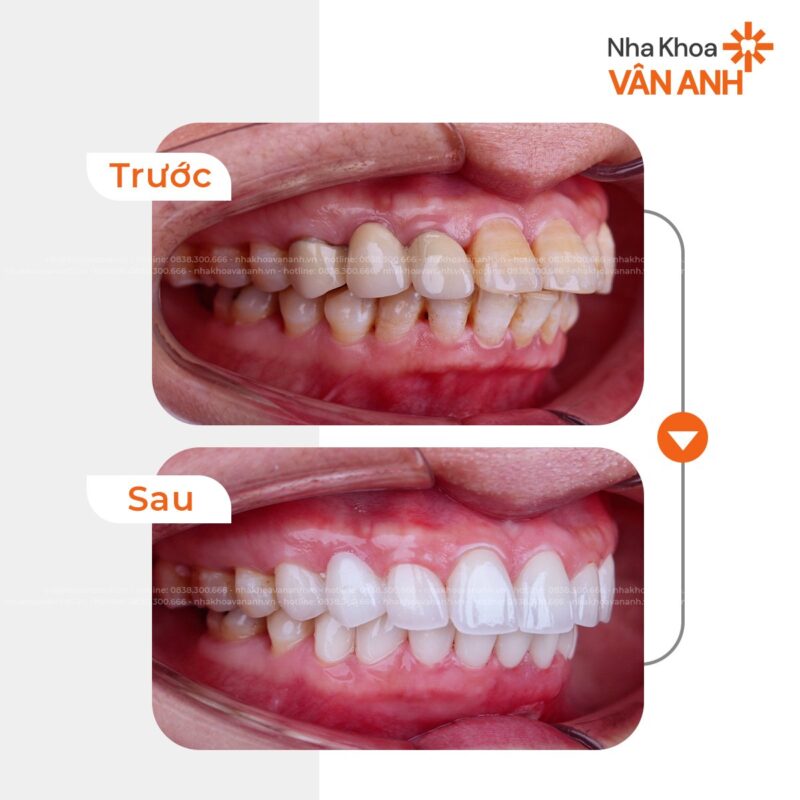 răng hô bọc sứ