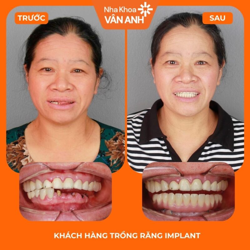 trồng răng implant toàn hàm nha khoa vân anh 1