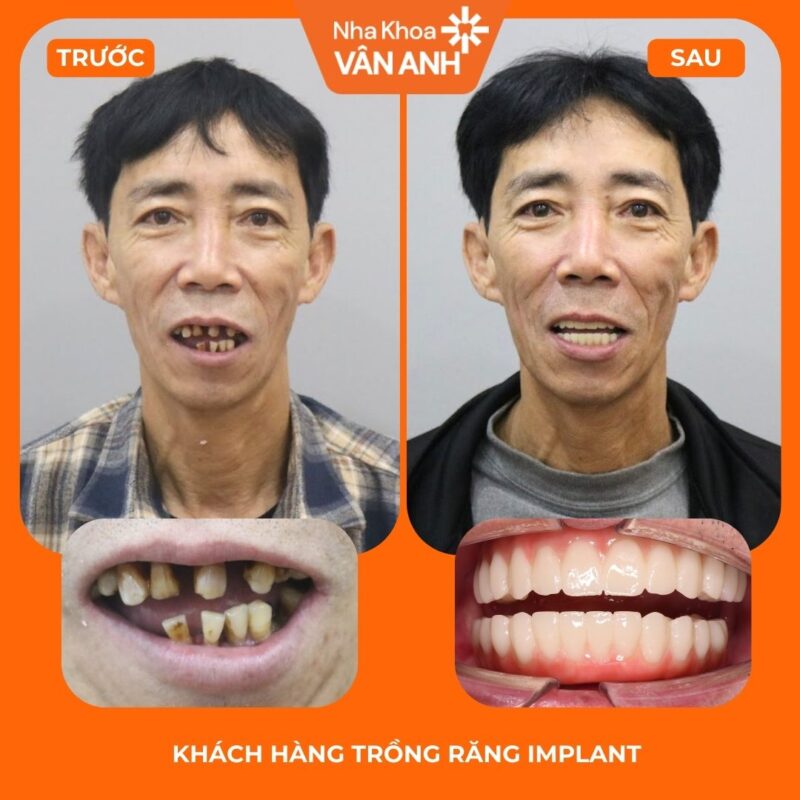 trồng răng implant toàn hàm nha khoa vân anh 1