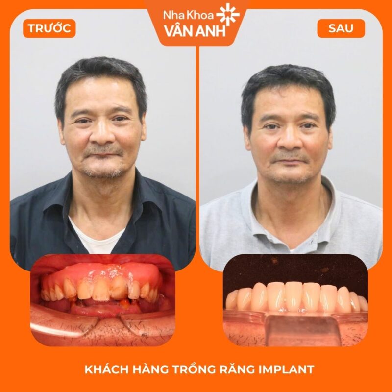 trồng răng implant toàn hàm nha khoa vân anh 1
