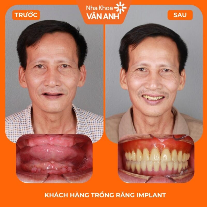 trồng răng implant toàn hàm nha khoa vân anh 1