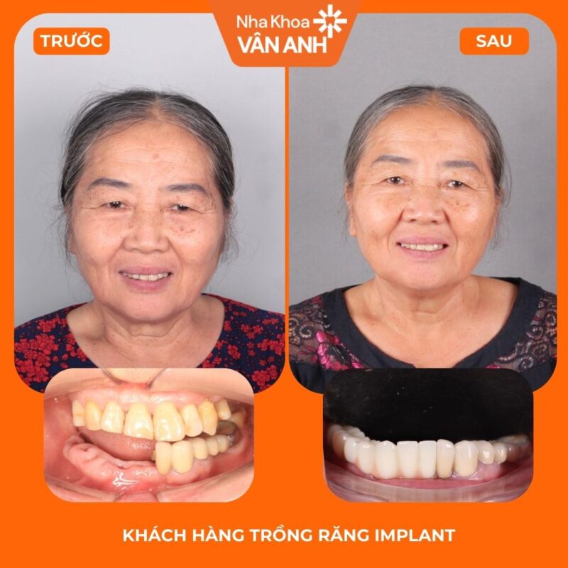 trồng răng implant toàn hàm nha khoa vân anh 1