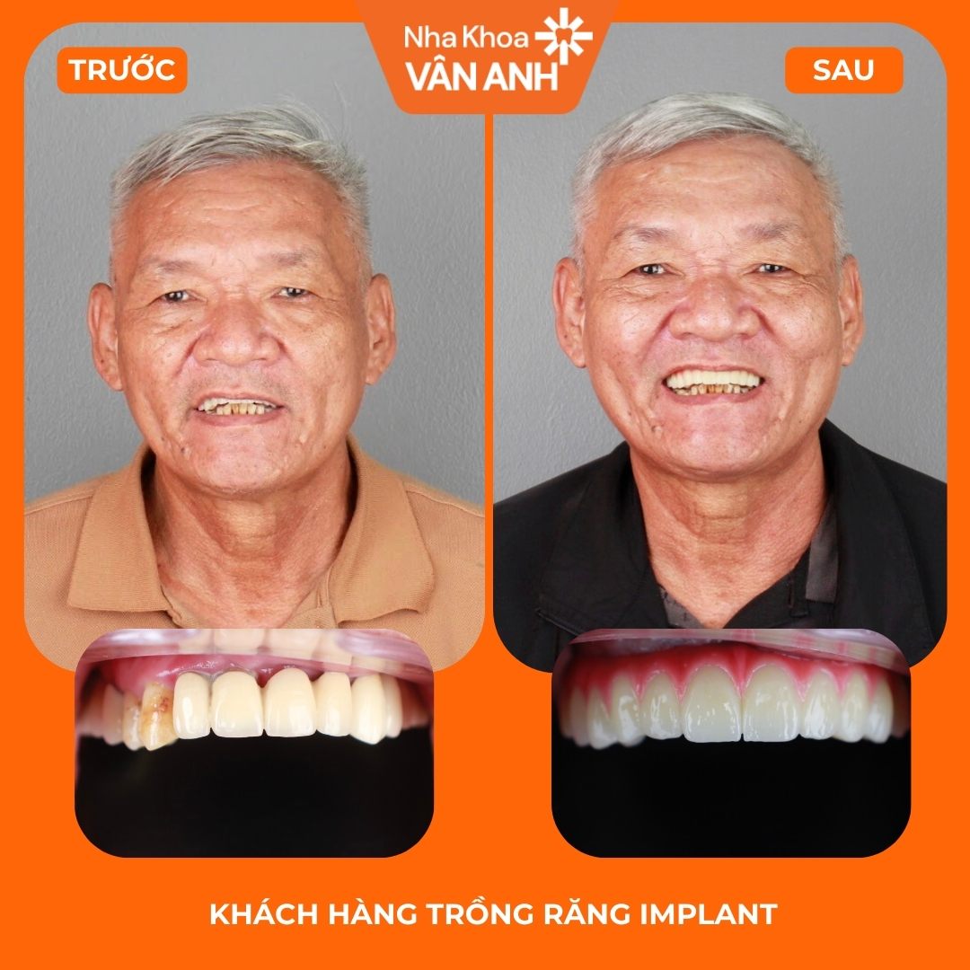 Ca 06 trước và sau điều trị