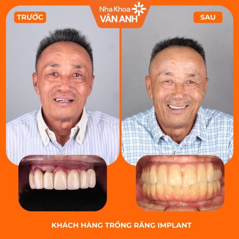 trồng răng implant toàn hàm nha khoa vân anh 1
