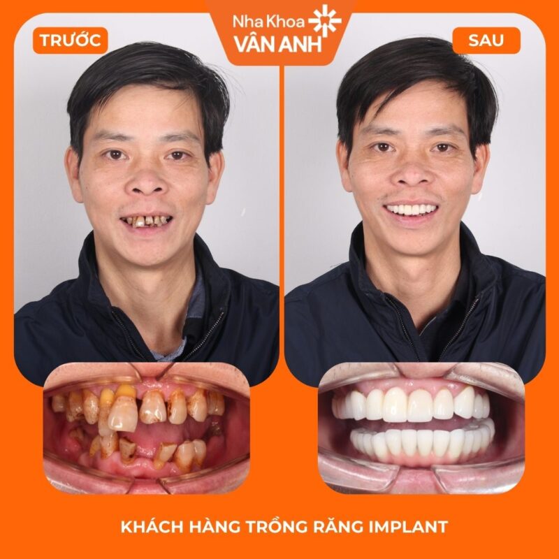 trồng răng implant toàn hàm nha khoa vân anh 1