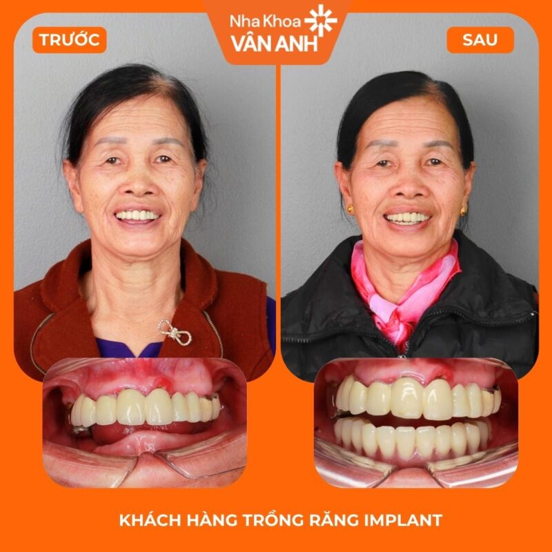 trồng răng implant toàn hàm nha khoa vân anh 1