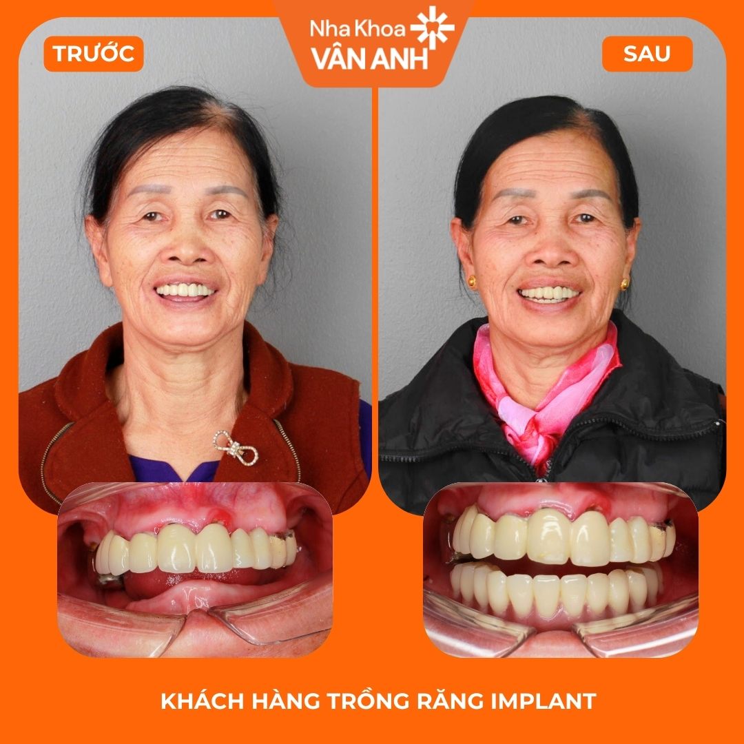 Ca 05 trước và sau điều trị