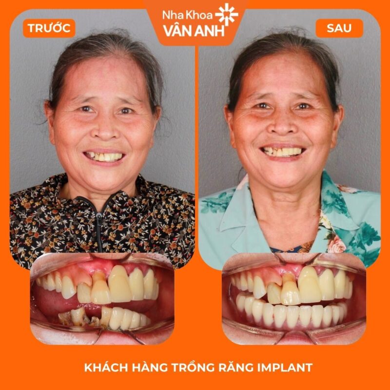 trồng răng implant toàn hàm nha khoa vân anh 1