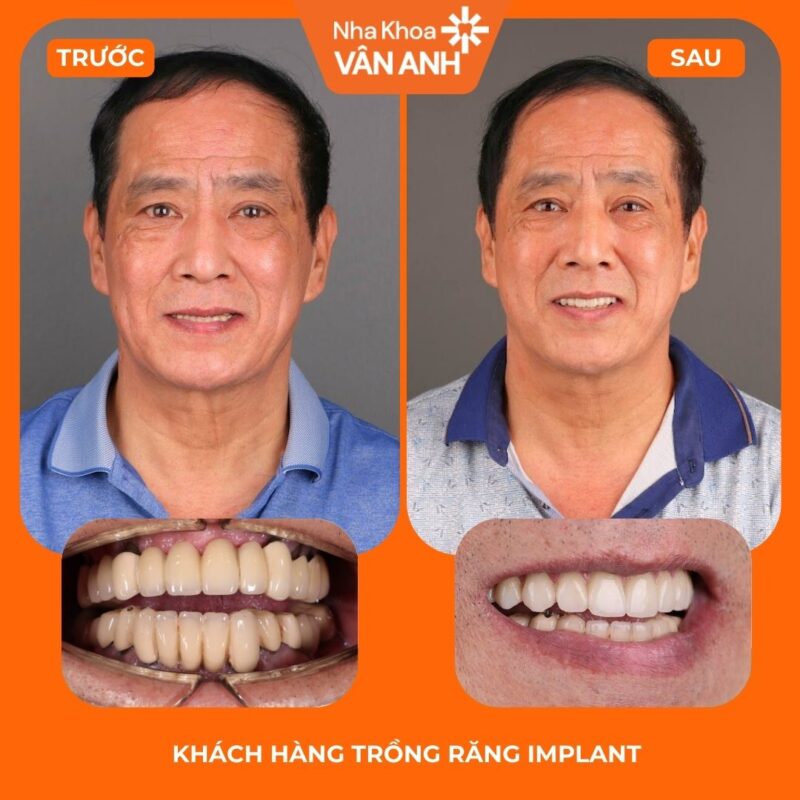 trồng răng implant toàn hàm nha khoa vân anh 1