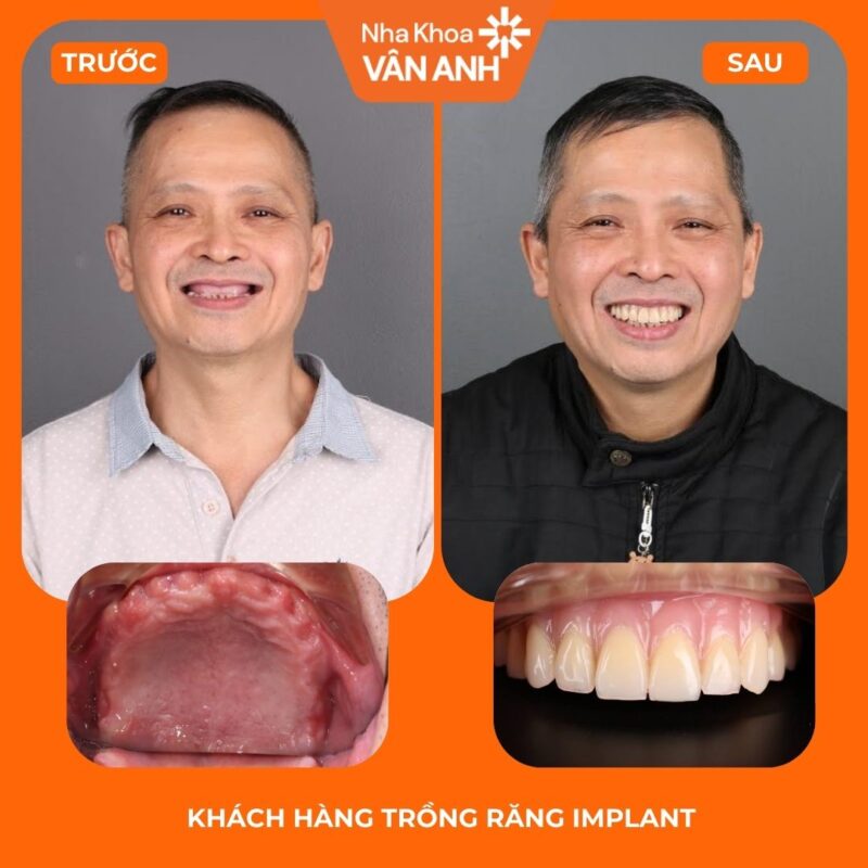 trồng răng implant toàn hàm nha khoa vân anh 1