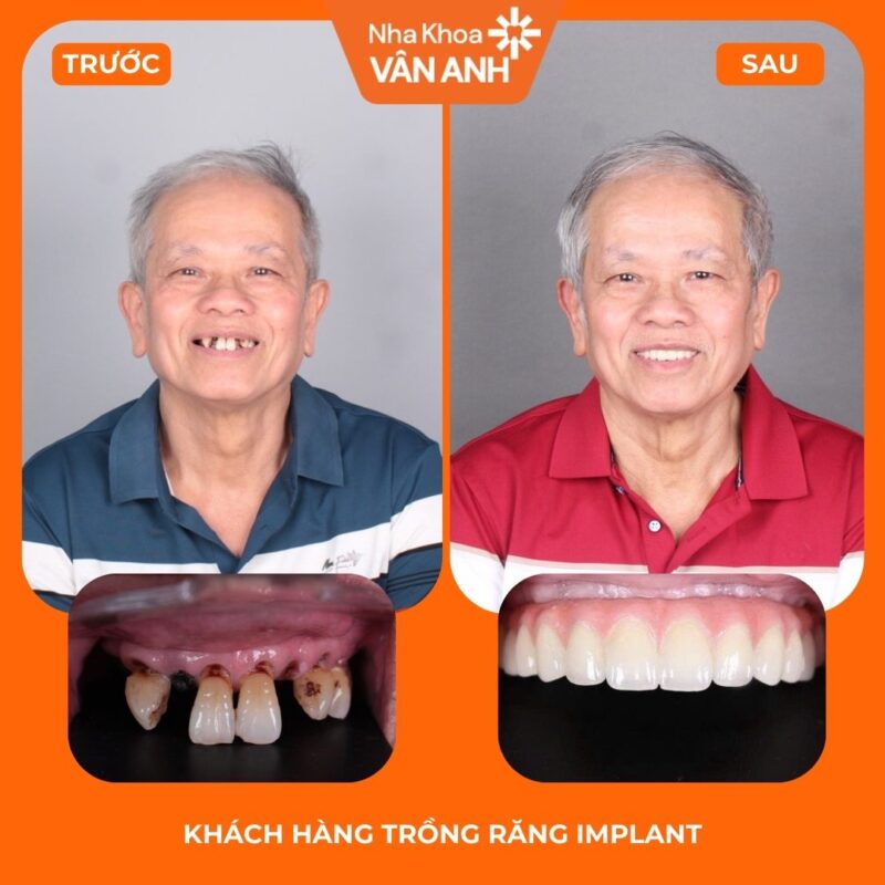 trồng răng implant toàn hàm nha khoa vân anh 1